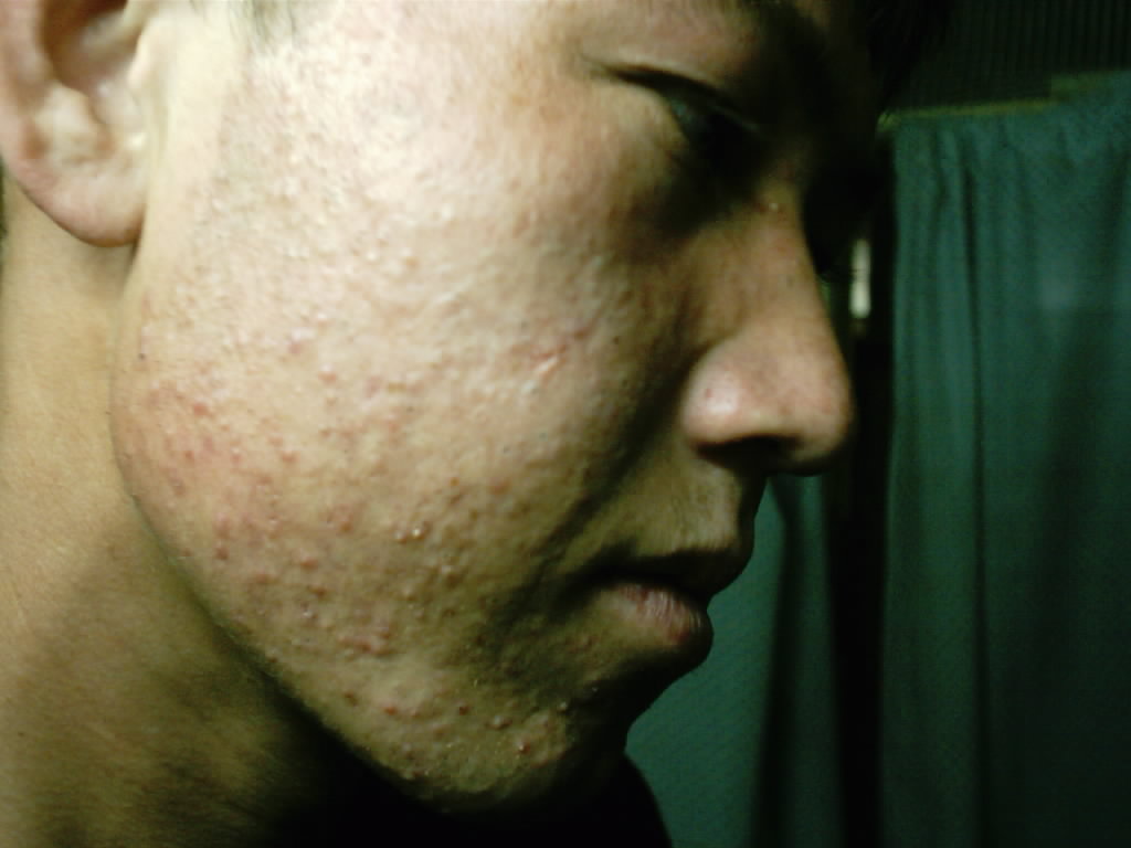 تداوی تخصصی جوانی دانه در شفاخانه جلدی آروین