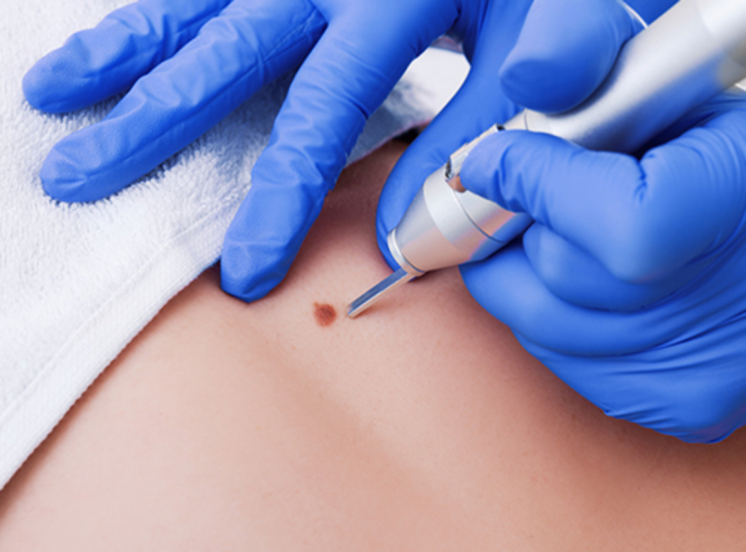 لیزر سره تور خالونه لری کول