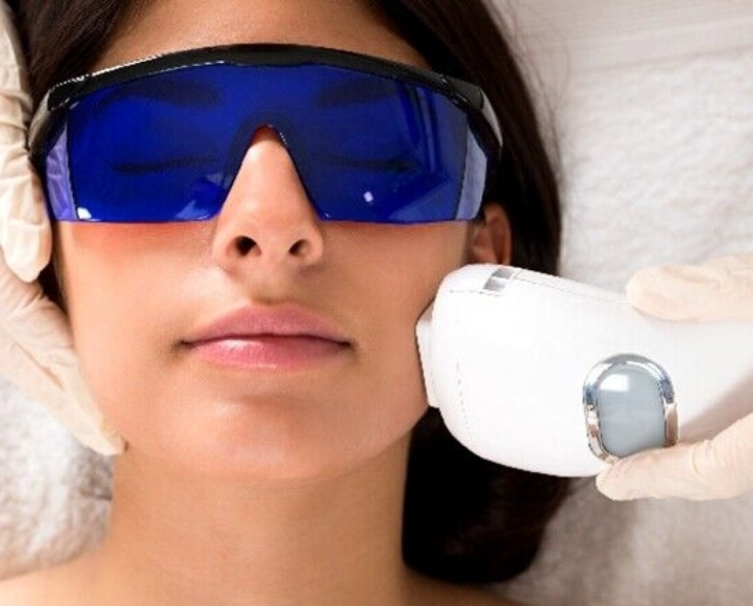 ازبین بردن مو های اضافی با لیزر 