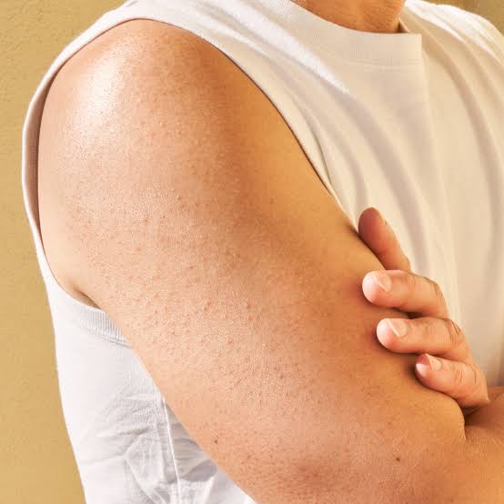 Scabies: A Severe Skin Condition Prevalent in Afghanistan