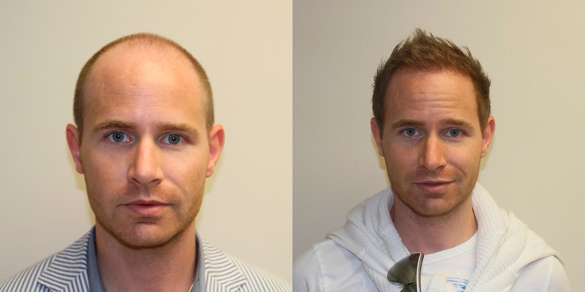 پی آر پی یا کاشت مو