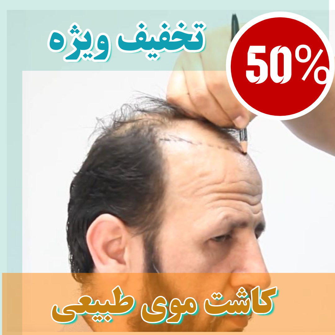 هزینه کاشت مو در کابل
