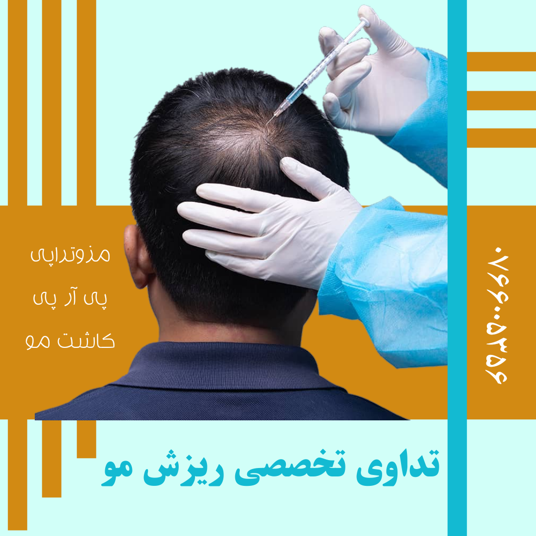 تداوی تخصصی ریزش مو