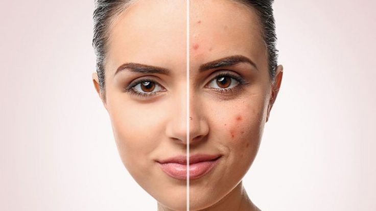 دلایل تشدید جوانی دانه