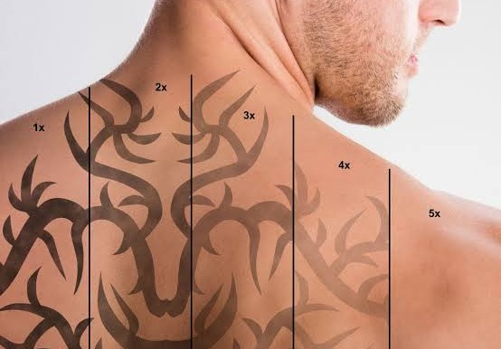 د شنه خالونو تداوي په اروین پوستکي روغتون کې: د تیتو د لیرې کولو لپاره د لیزر پیکو، عصري میتود کارول