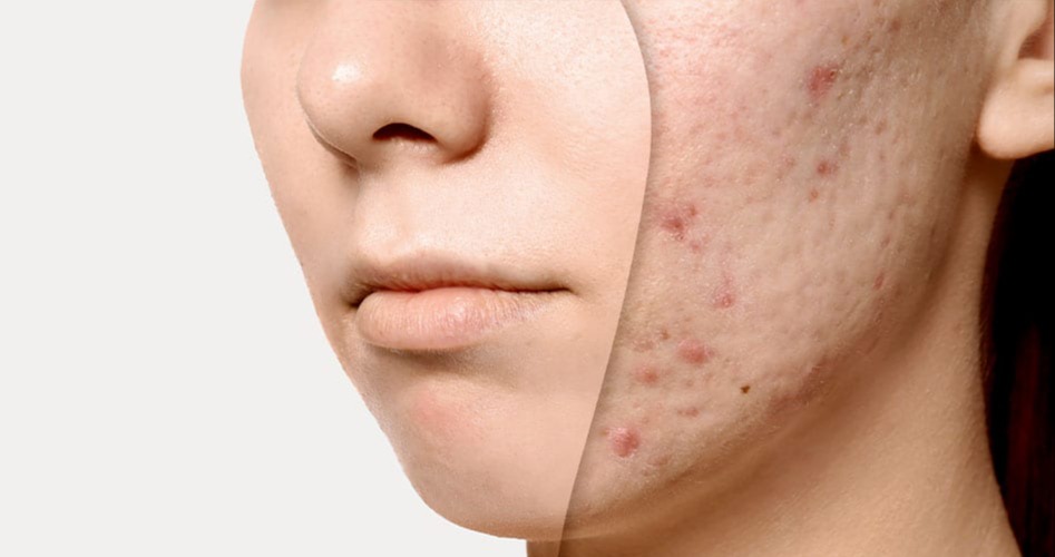 4 Cosmetic Procedures for Acne Treatment – Arvin Skin Hospital