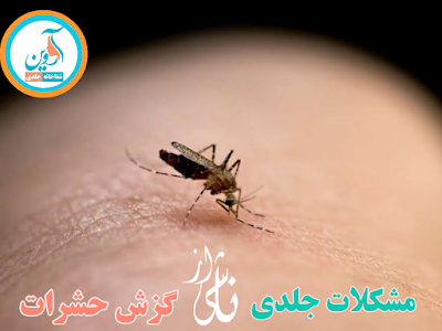 گزش یا گزیدن حشرات