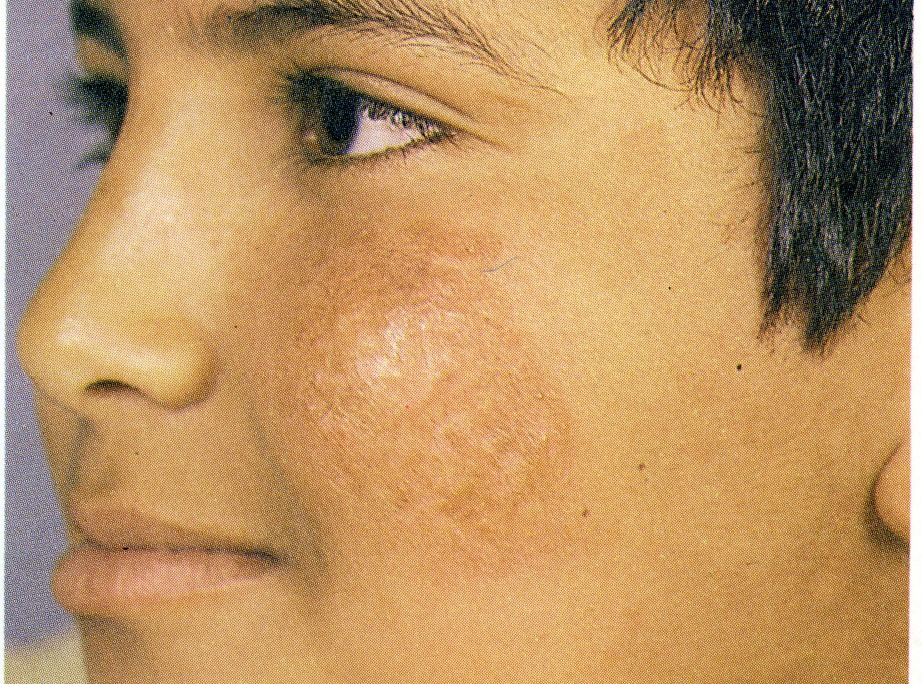 تداوی داغ سالدانه در شفاخانه جلدی آروین