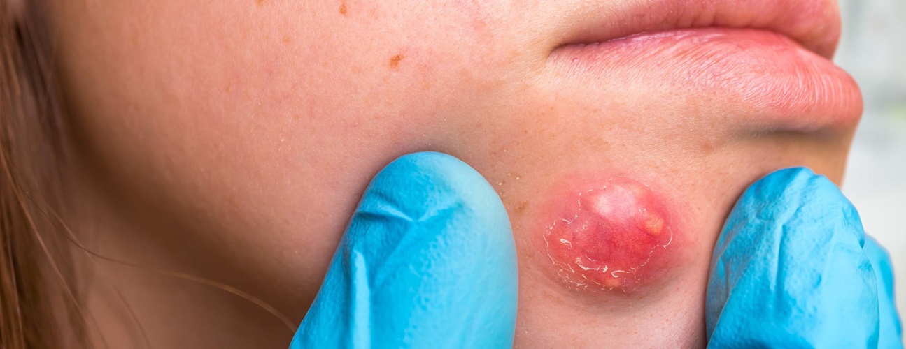 وقایه و تداوی بیخ‌ کته 