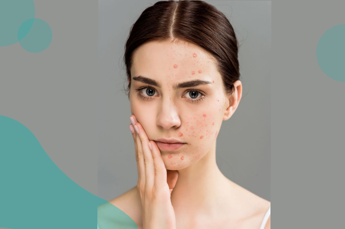 Top 8 Acne Triggers