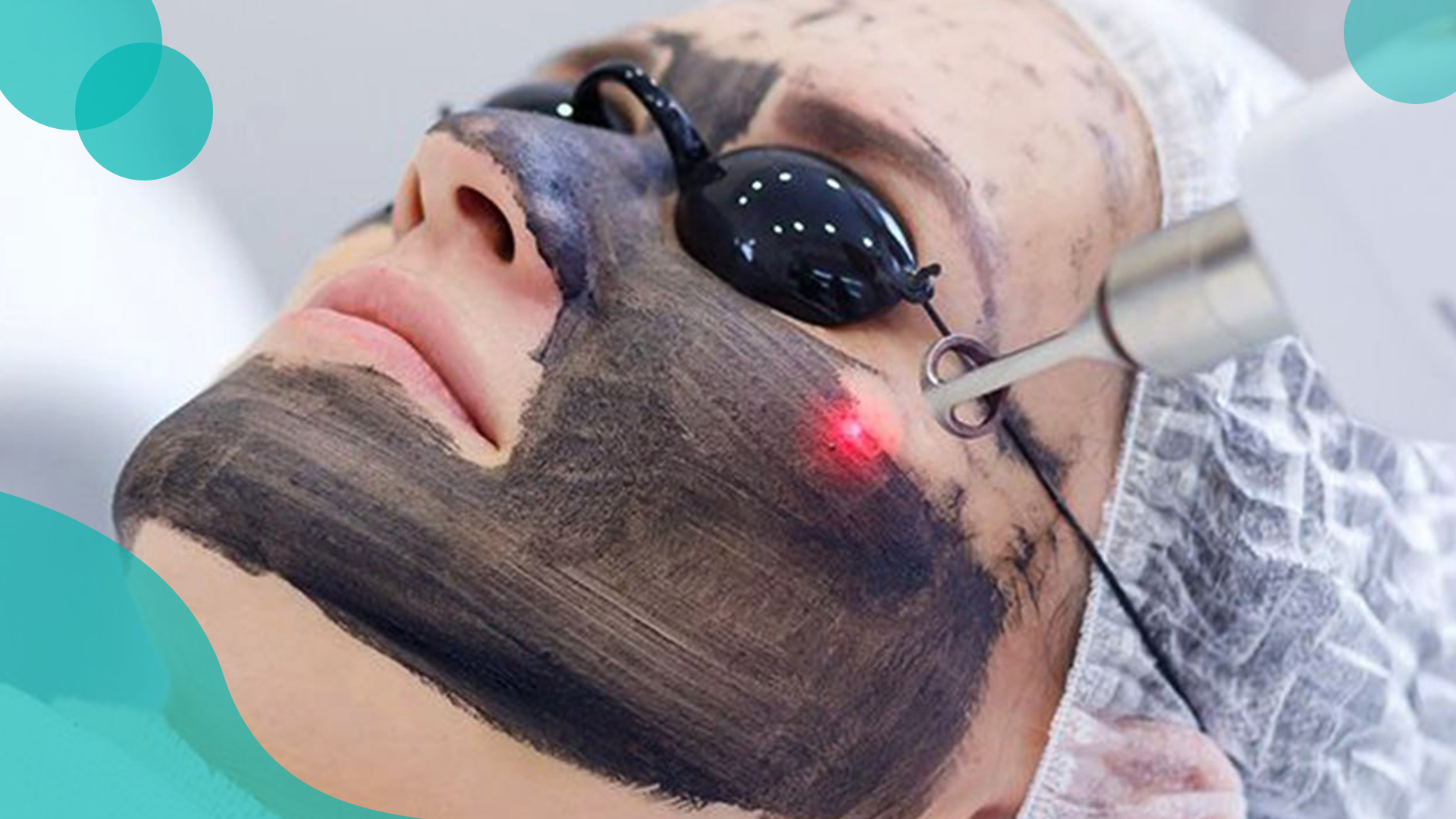 کاربن پیل: روشی نوین برای جوان‌سازی و شفافیت پوست در شفاخانه جلدی آروین