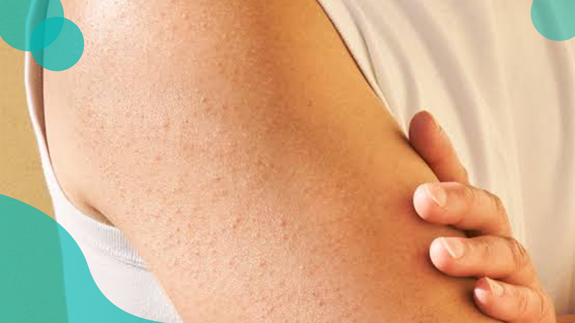 Scabies: A Severe Skin Condition Prevalent in Afghanistan