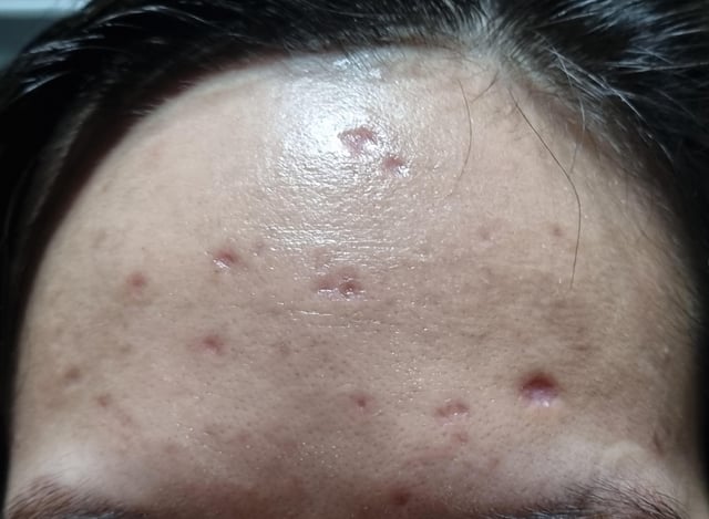 تداوی داغ آب چیچک 