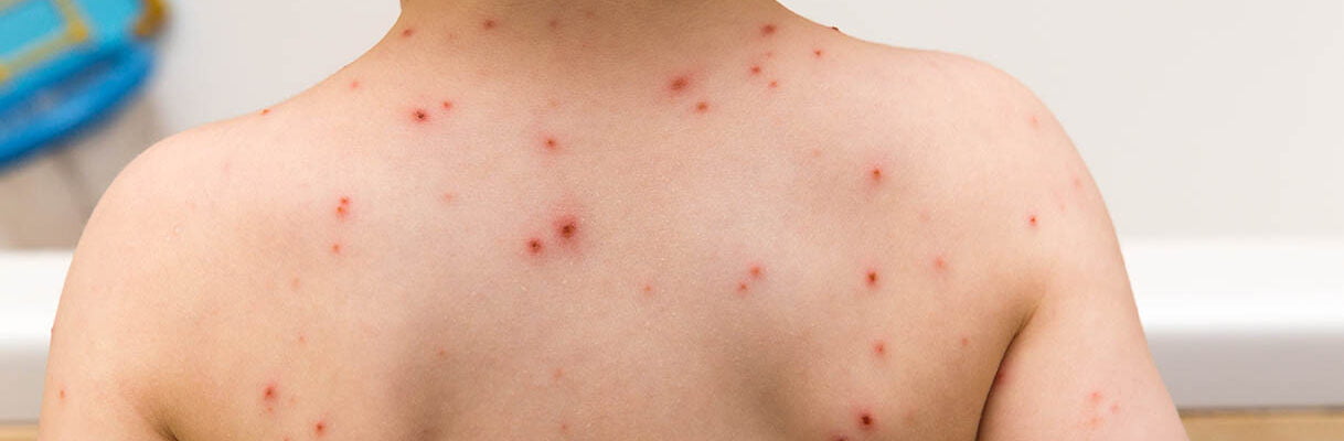 تداوی آب چیچک