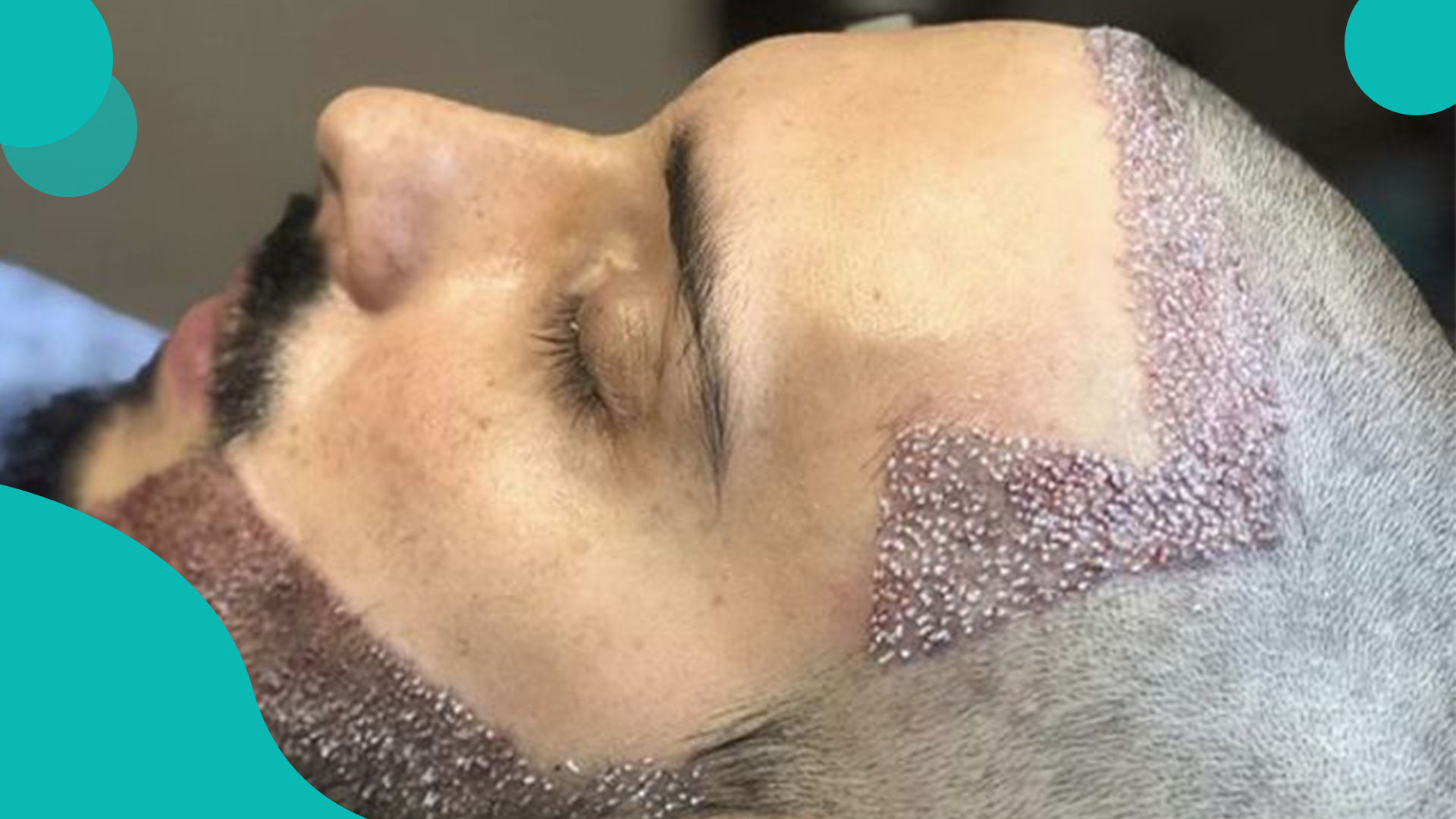 کاشت مو در کابل