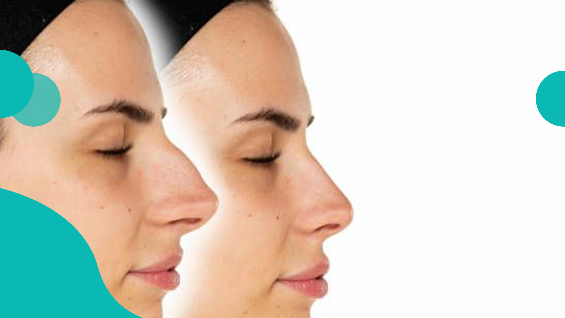 جراحی زیبایی بینی 