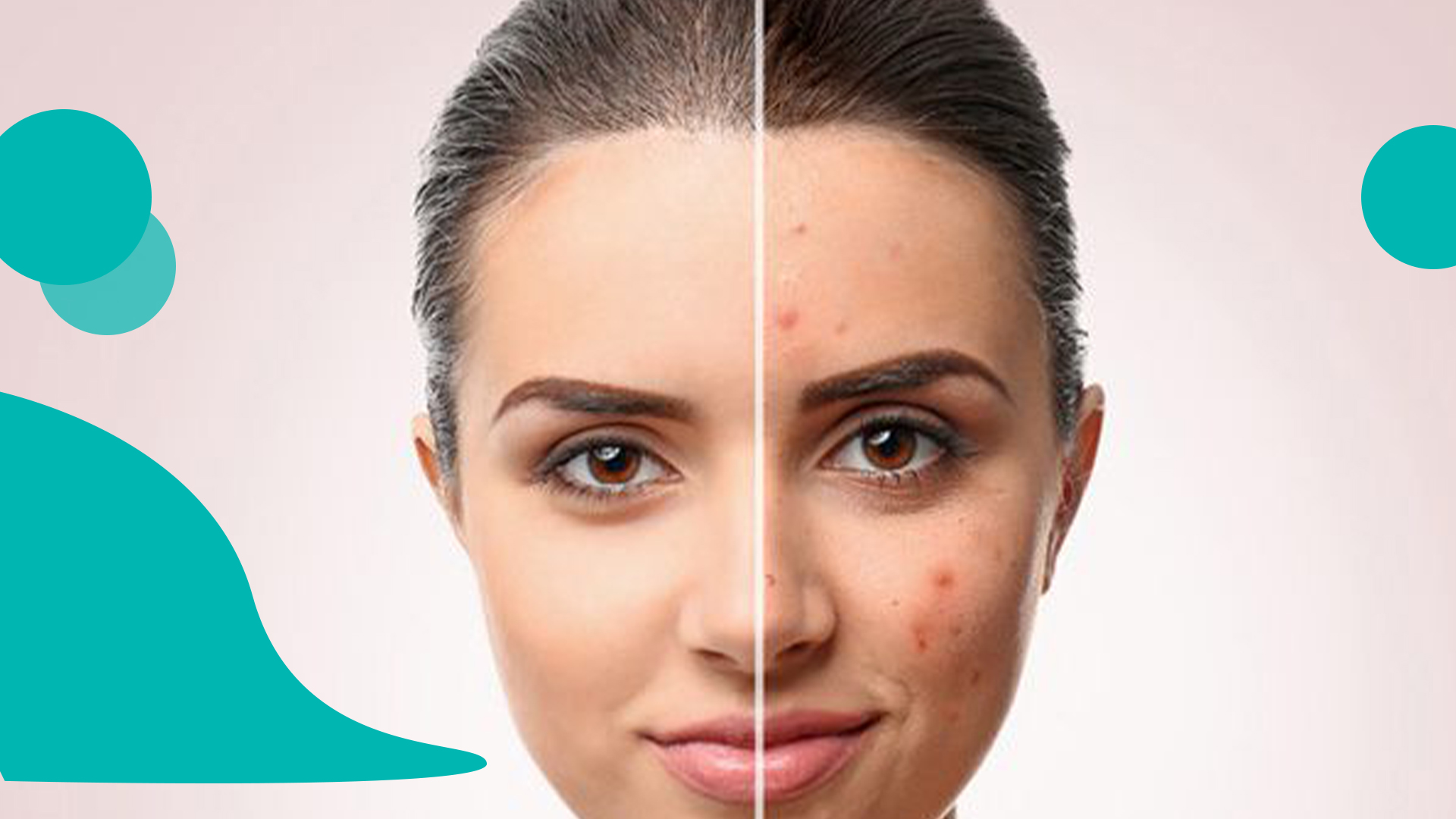 تداوی تخصصی داغ جوانی دانه 