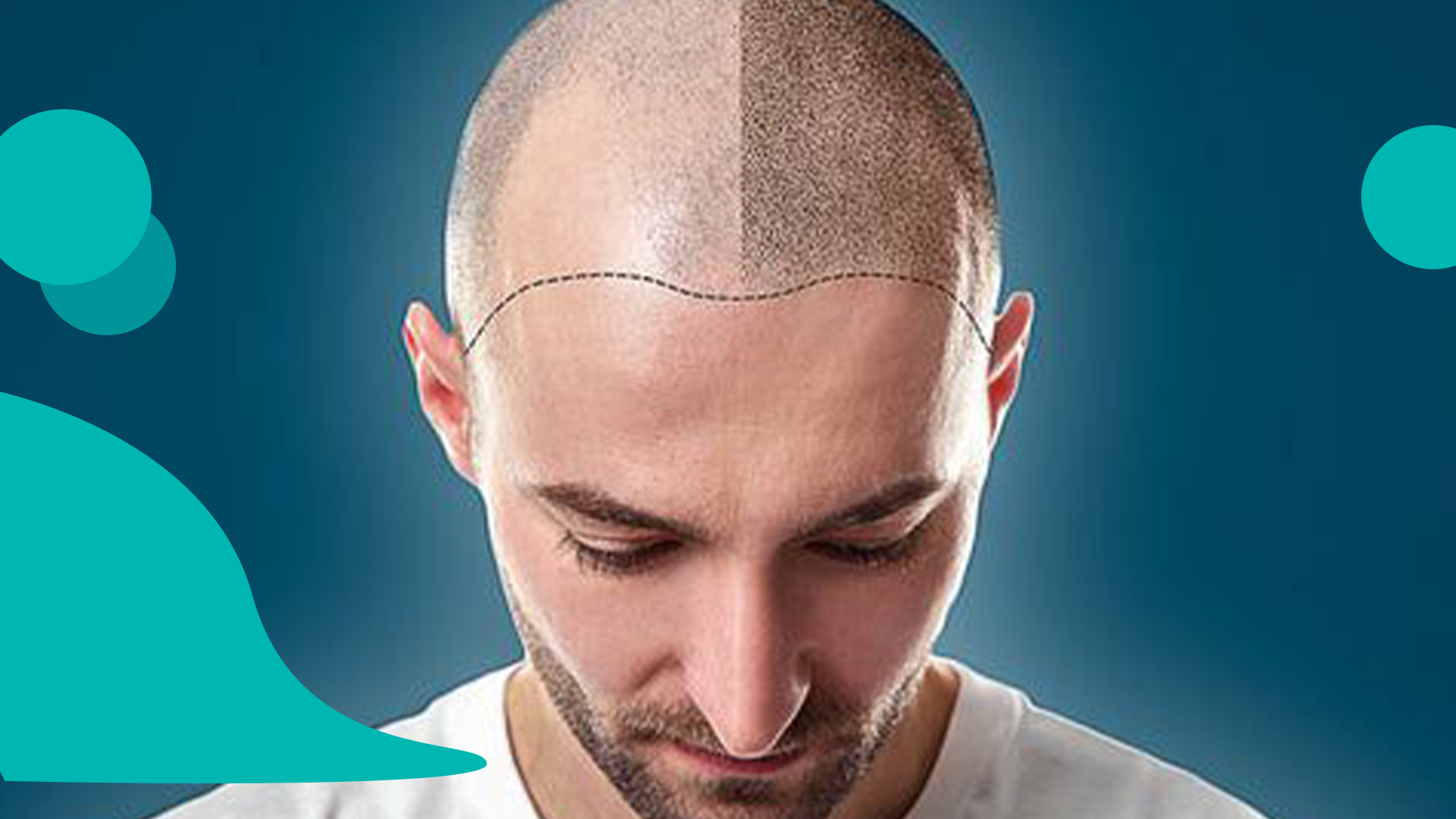 هزینه کاشت مو در کابل 