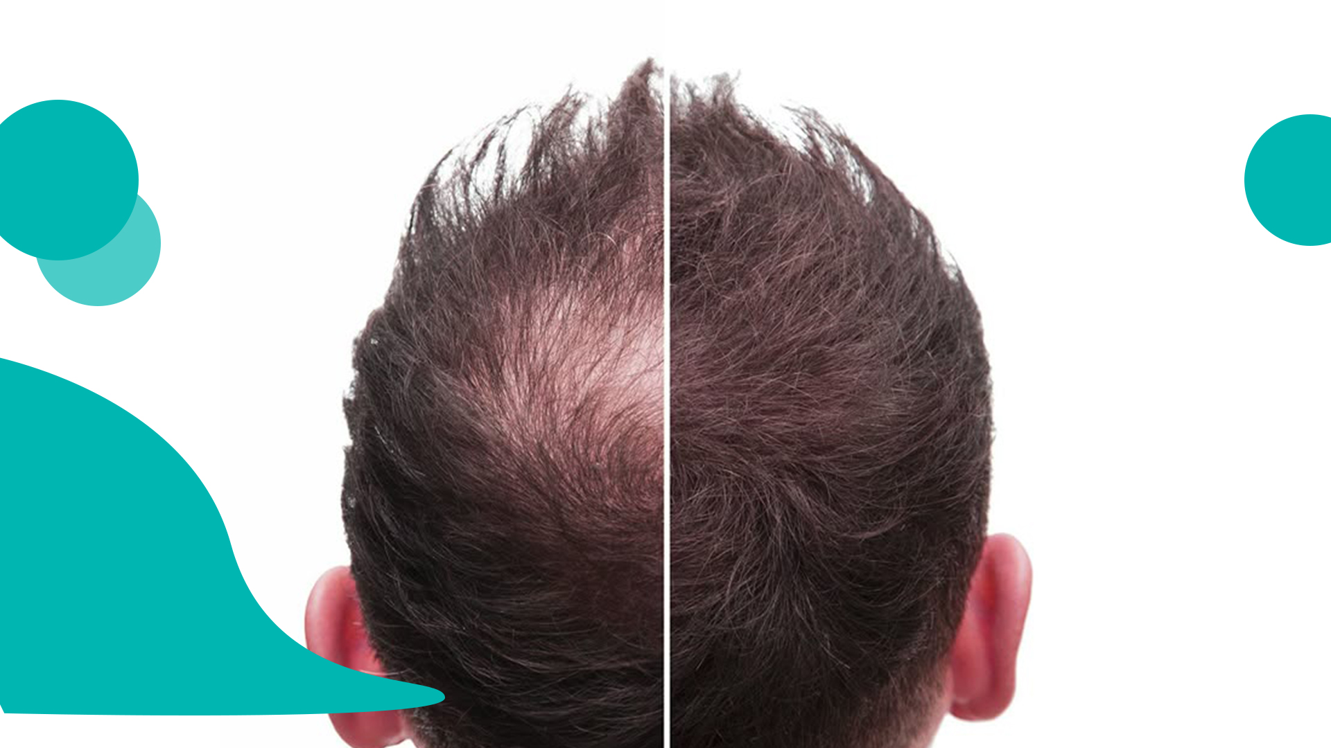 مراحل رشد مو پس از کاشت مو