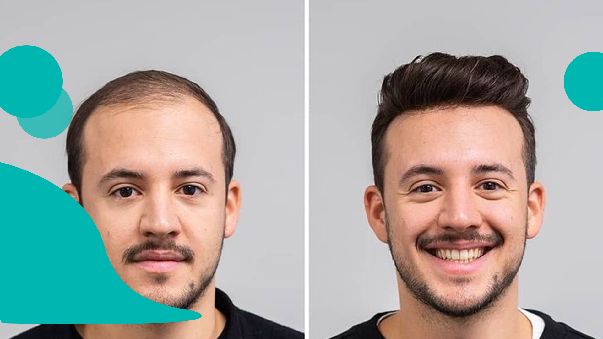 اشخاص مناسب به کاشت مو