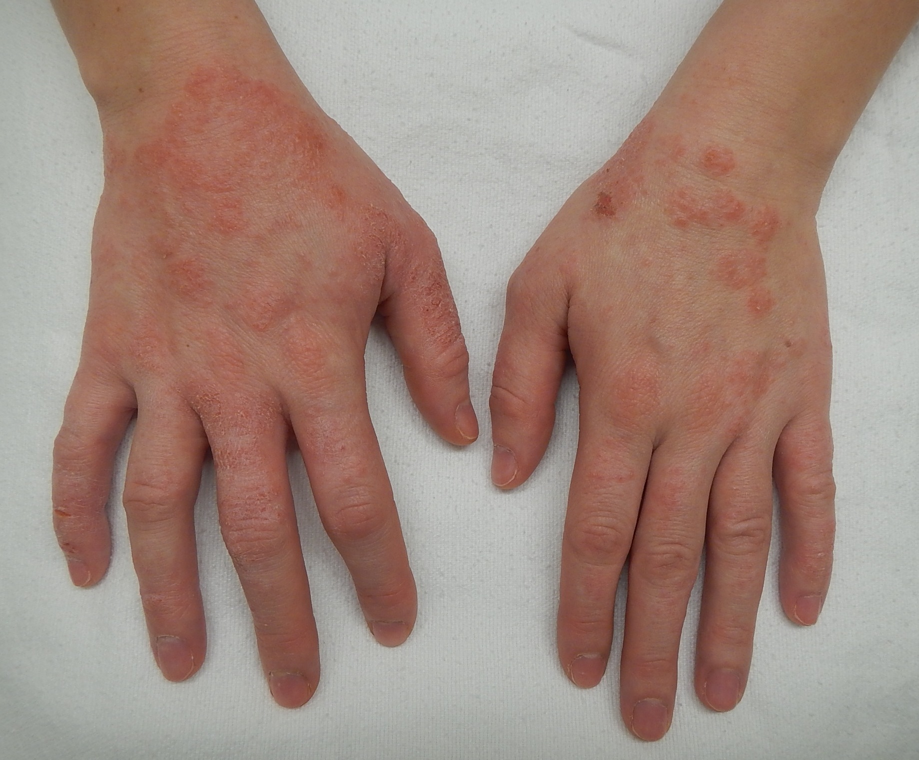 Eczema & Dermatitis 