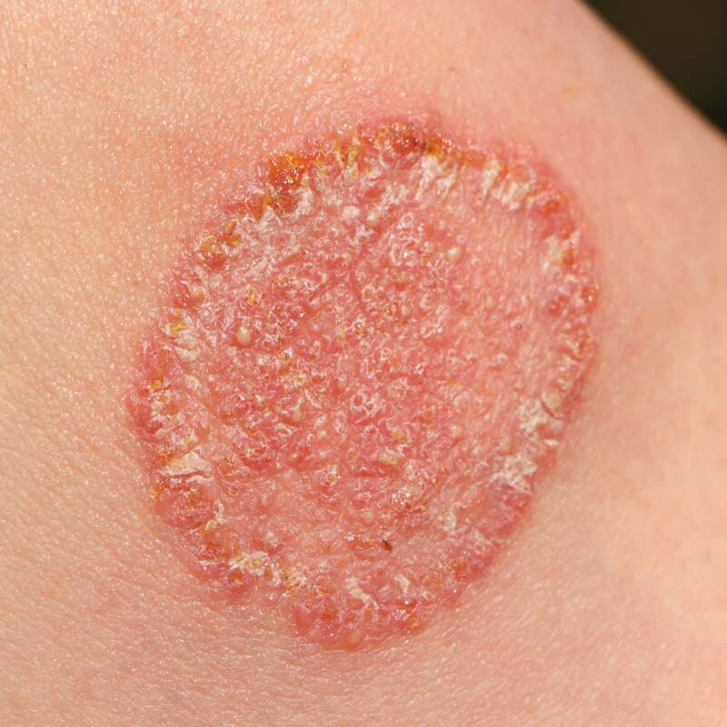 Fungal Infections