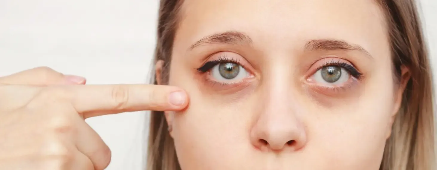 سیاهی زیر چشم؛ دلایل و بهترین روش‌های تداوی در شفاخانه جلدی اروین