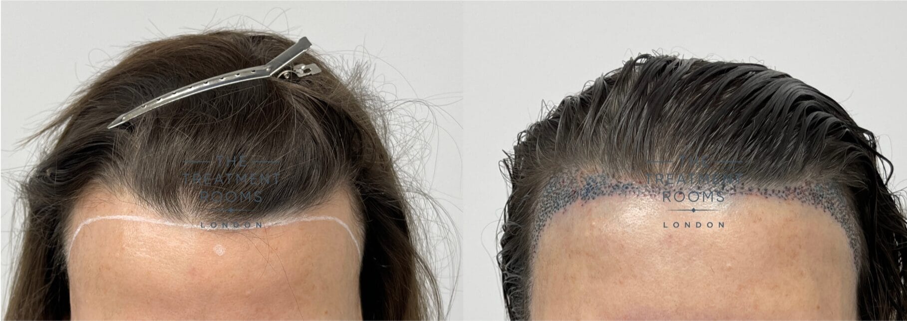 د ښځو د ویښتو کښت