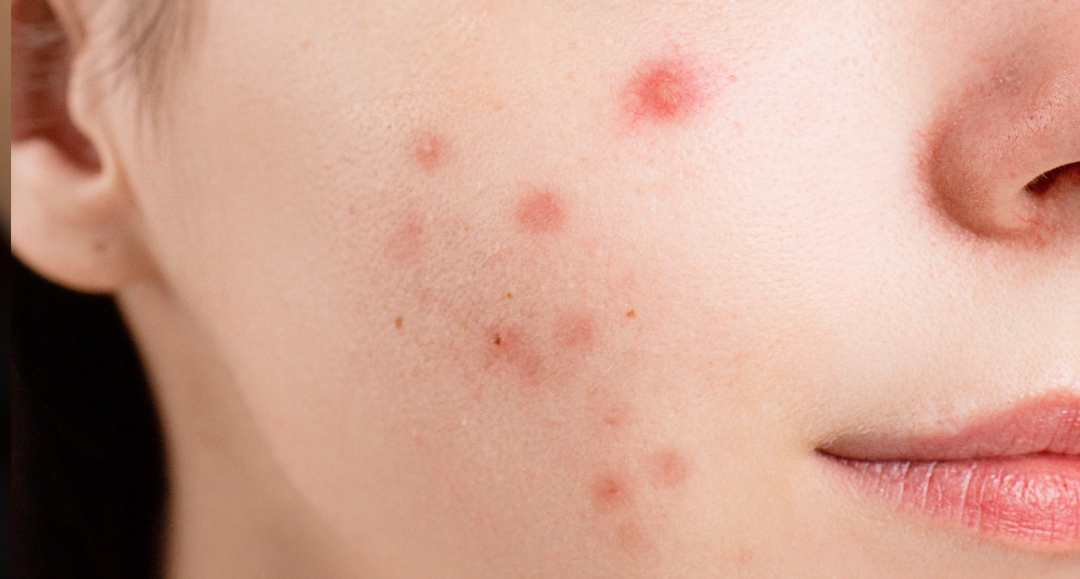 Diagnosis and Treatment of Different Types of Acne (Youth Acne ...